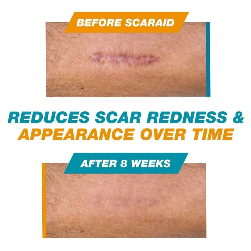 SCAR SOLUTIONS - Silicone Scar Stick - For Face and Body - Image 3
